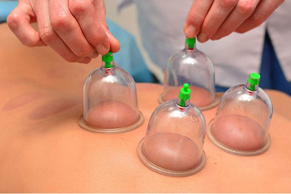 Cupping Therapy