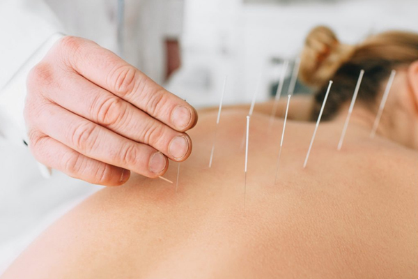 Dry Needling Therapy Services in Gurgaon