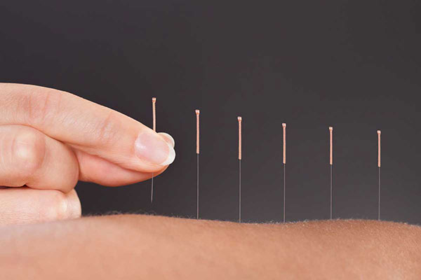 Dry Needling